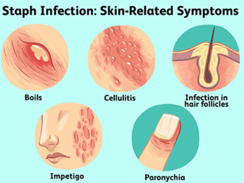 عفونت استاف؛ علائمی که نباید نادیده بگیرید